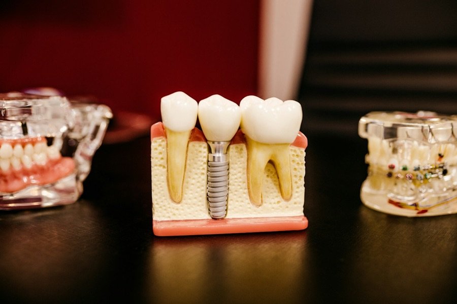 Modelo de implante dental entre dos dientes