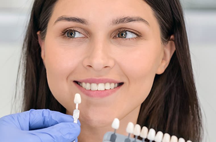 Guía de color dental junto a una sonrisa