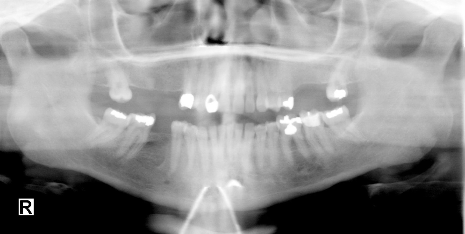 Radiografía panorámica dental